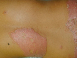 Lepra tuberculoide limítrofe con reacción tipo 1