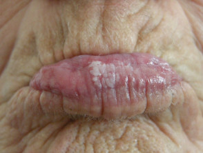 Leucoplasia oral