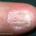 lichen-planus-matrix__protectwyjqcm90zwn0il0_focusfillwzi5ncwymjisingildfd-8328513-5789302-jpg-1903319