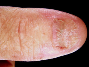 Flecken penis weiße Balanitis: Entzündung