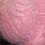 lichen-simplex-scrotum-003__protectwyjqcm90zwn0il0_focusfillwzi5ncwymjisinkildu2xq-2310086-9908936-jpg-2132906
