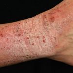 lichen-simplex1__protectwyjqcm90zwn0il0_focusfillwzi5ncwymjisingilde5xq-4082248-7423661-jpg-8879534