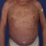 lichenoid-drug1__protectwyjqcm90zwn0il0_focusfillwzi5ncwymjisingildfd-8293887-7154784-jpg-7011886