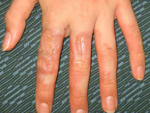 Dermatitis por fotocontacto