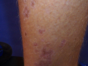 Poroqueratosis lineal