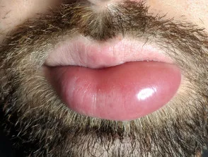 Angioedema del labbro