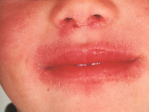 Dermatitis del lamedor de labios