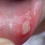 lip-ulcer__protectwyjqcm90zwn0il0_focusfillwzi5ncwymjisingildfd-7887695-6388647-jpg-2190192