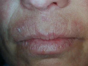 Cheilitis als gevolg van haarkleurstofallergie