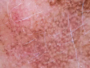 Patrón granular anular visto en dermatoscopia de lentigo maligno