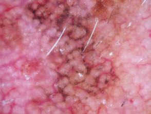 Patrón granular anular y romboides en dermatoscopia de lentigo maligno