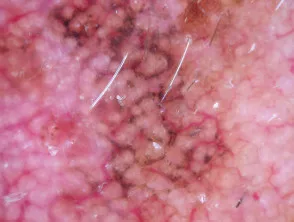 Patrón granular anular y romboides en dermatoscopia de lentigo maligno