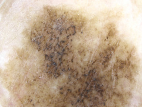 Patrón granular anular y romboides visto en dermatoscopia de melanoma lentigo maligno