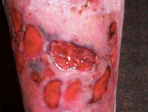 Úlceras en las piernas