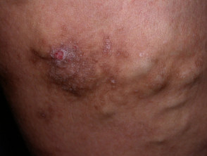 Dermatitis varicosa
