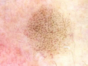 Patrón granular anular visto en dermatoscopia de queratosis similar a liquen plano