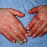 lupus-erythematosus-067__protectwyjqcm90zwn0il0_focusfillwzi5ncwymjisingildfd-1095194-7278165-jpg-5552954