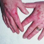 lupus-hand__protectwyjqcm90zwn0il0_focusfillwzi5ncwymjisingildizxq-9031940-4399502-jpg-6260660
