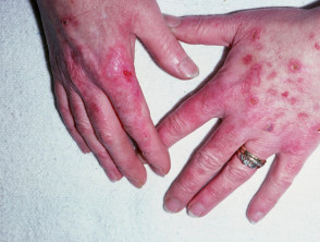 Lupus eritematoso discoide que afecta las manos dorsales