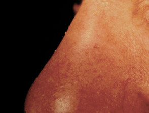 Lupus pernio.  Sarcoidosis cutánea