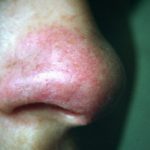 lupus-pernio__protectwyjqcm90zwn0il0_focusfillwzi5ncwymjisinkildk1xq-6974576-7384162-jpg-9276891