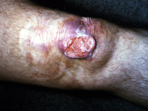 Tuberculosis cutánea: lupus vulgaris con carcinoma de células escamosas