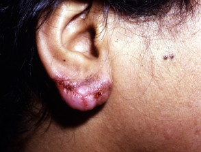 Tuberculosis cutánea: lupus vulgaris
