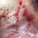 lymphangiectasia1__protectwyjqcm90zwn0il0_focusfillwzi5ncwymjisingildfd-2158895-2512894-jpg-5490385
