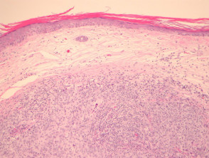 Linfoepitelioma patología de carcinoma