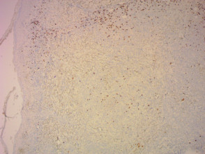 Pathologie der lymphomatoiden Papulose, gefärbt mit CD8x40