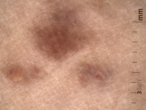 Placa linfoplasmocítica: dermatoscopia