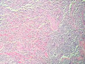 Mastocitosis cutánea maculopapular