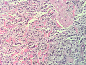 Mastocitosis cutánea maculopapular