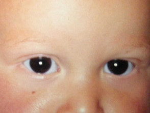 Bebé con madarosis por alopecia areata
