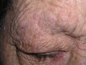 Madarosis por dermatitis atópica