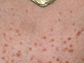 Folliculitis Malassezia