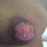 mammary-paget-04__protectwyjqcm90zwn0il0_focusfillwzi5ncwymjisingildfd-8260392-5648818-jpg-2499065