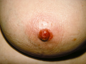 Enfermedad de Paget mamaria de la piel