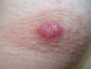 Enfermedad de Paget mamaria de la piel