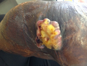 Úlcera de Marjolin en cicatriz de quemadura térmica