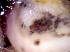 Dermatoscopia de melanoma lentiginoso acral