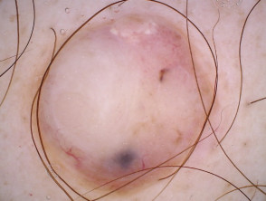 Dermatoscopia de melanoma