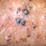 melanoma-181__protectwyjqcm90zwn0il0_focusfillwzi5ncwymjisingildfd-9932299-1639050-jpg-5774723