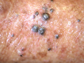 Metástasis de melanoma cutáneo