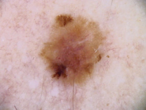 Dermatoscopia de melanoma de extensión superficial en adolescente