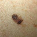 melanoma-abcd-01__protectwyjqcm90zwn0il0_focusfillwzi5ncwymjisingildfd-7699157-3350991-jpg-6282076