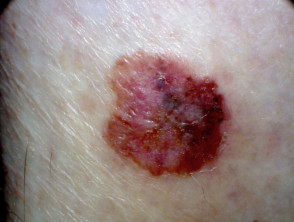 ABCD melanoma