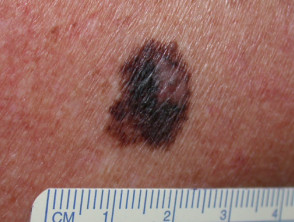 ABCD melanoma
