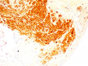 Patología del melanoma foliculotrópico teñido con S100 x100