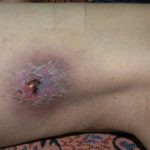melioidosis-1__protectwyjqcm90zwn0il0_focusfillwzi5ncwymjisingildfd-1774038-2870253-jpg-5701325